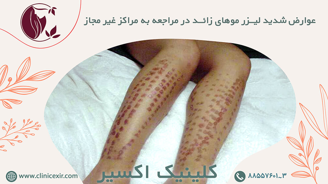 عوارض لیزر موهای زائد چیست و چگونه از آن جلوگیری کنیم ؟ - کلینیک زیبایی اکسیر