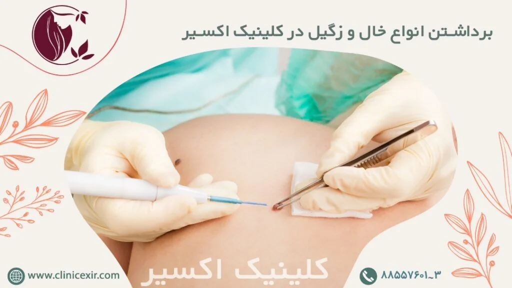 برداشتن انواع خال و زگیل در کلینیک اکسیر