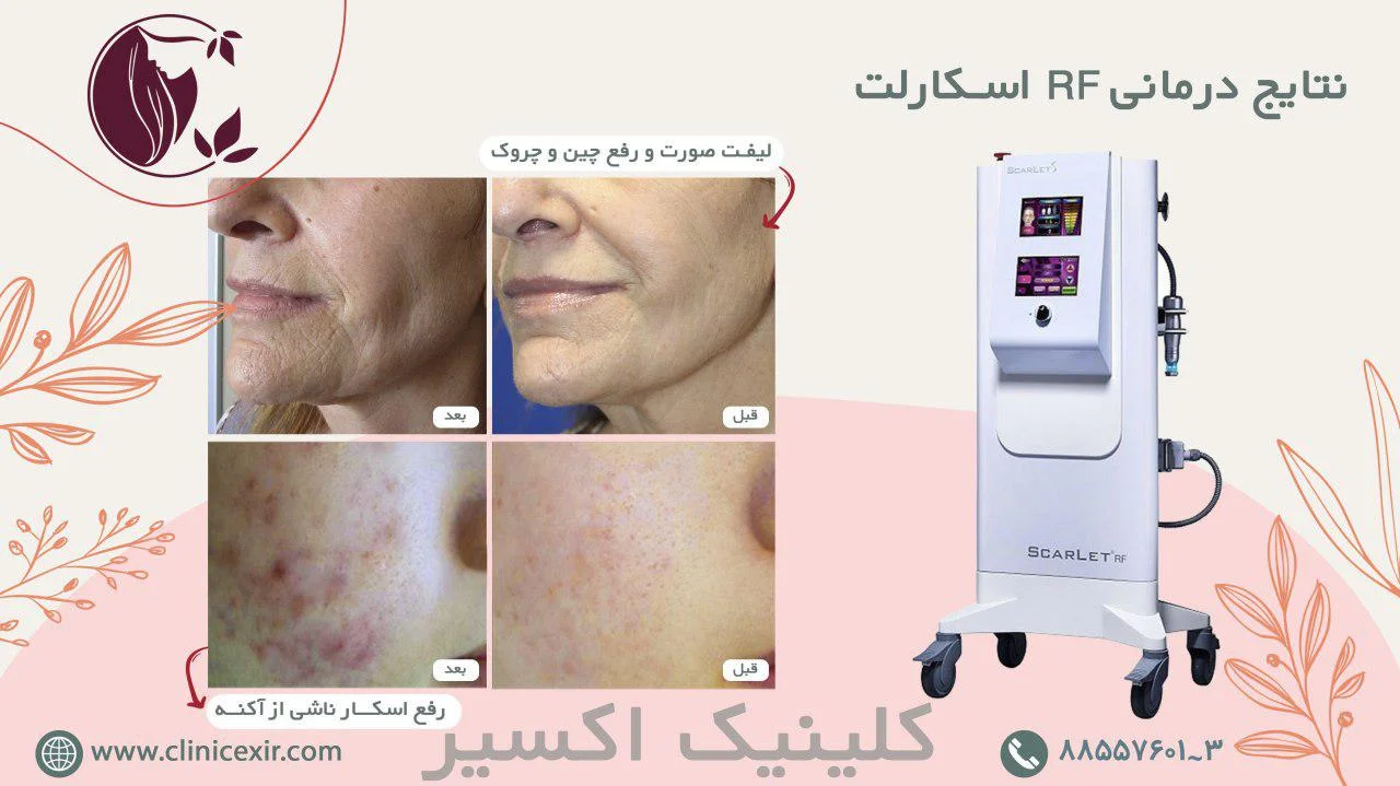 نتایج آر اف فرکشنال
