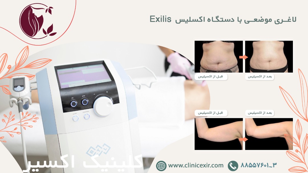 دستگاه لاغری اکسلیس Exilis