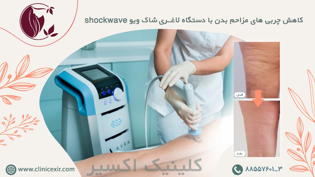 دستگاه لاغری شاک ویو shockwave