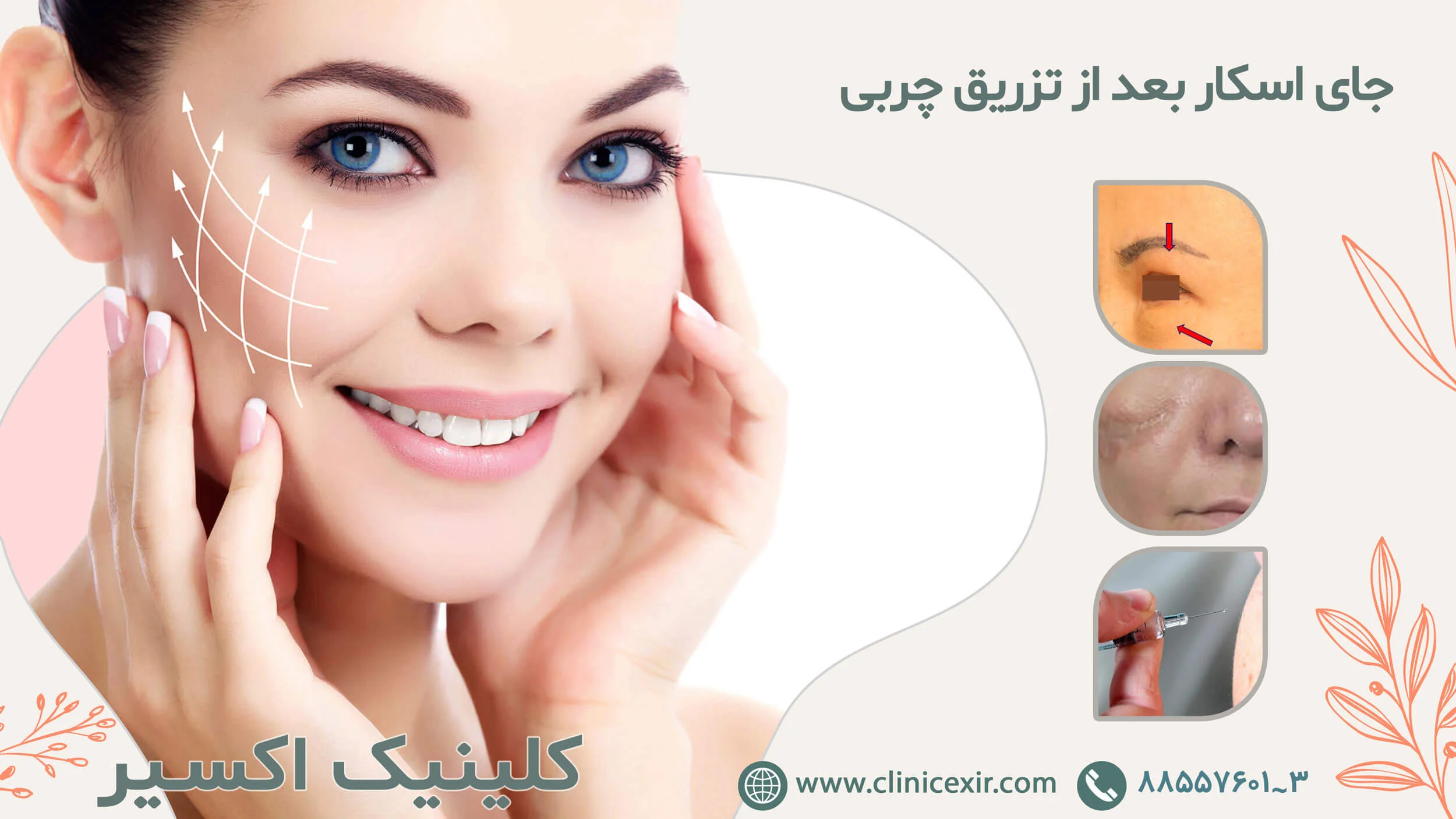 جای اسکار بعد از تزریق چربی تزریق چربی دائمی