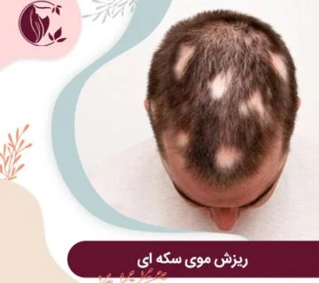 ریزش موی سکه ای