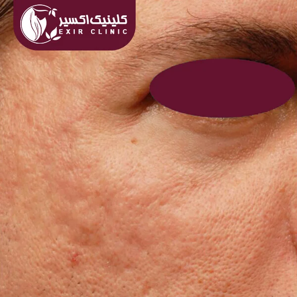 نمونه لیزر RF
