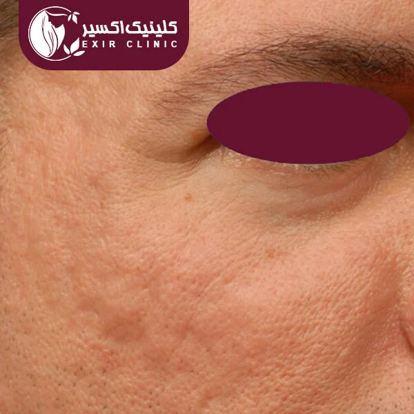 نمونه لیزر RF