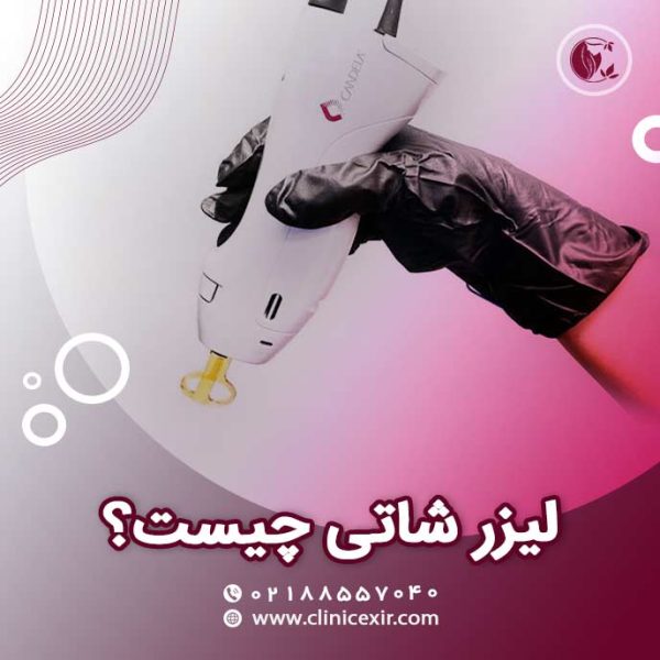 لیزر شاتی