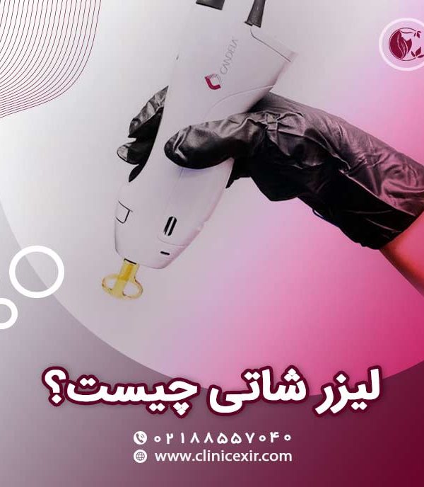 لیزر شاتی