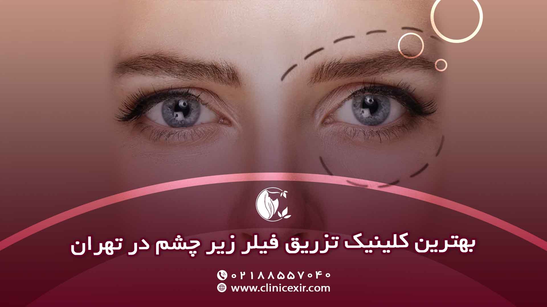 بهترین کلینیک زیبایی تزریق فیلر زیر چشم در تهران