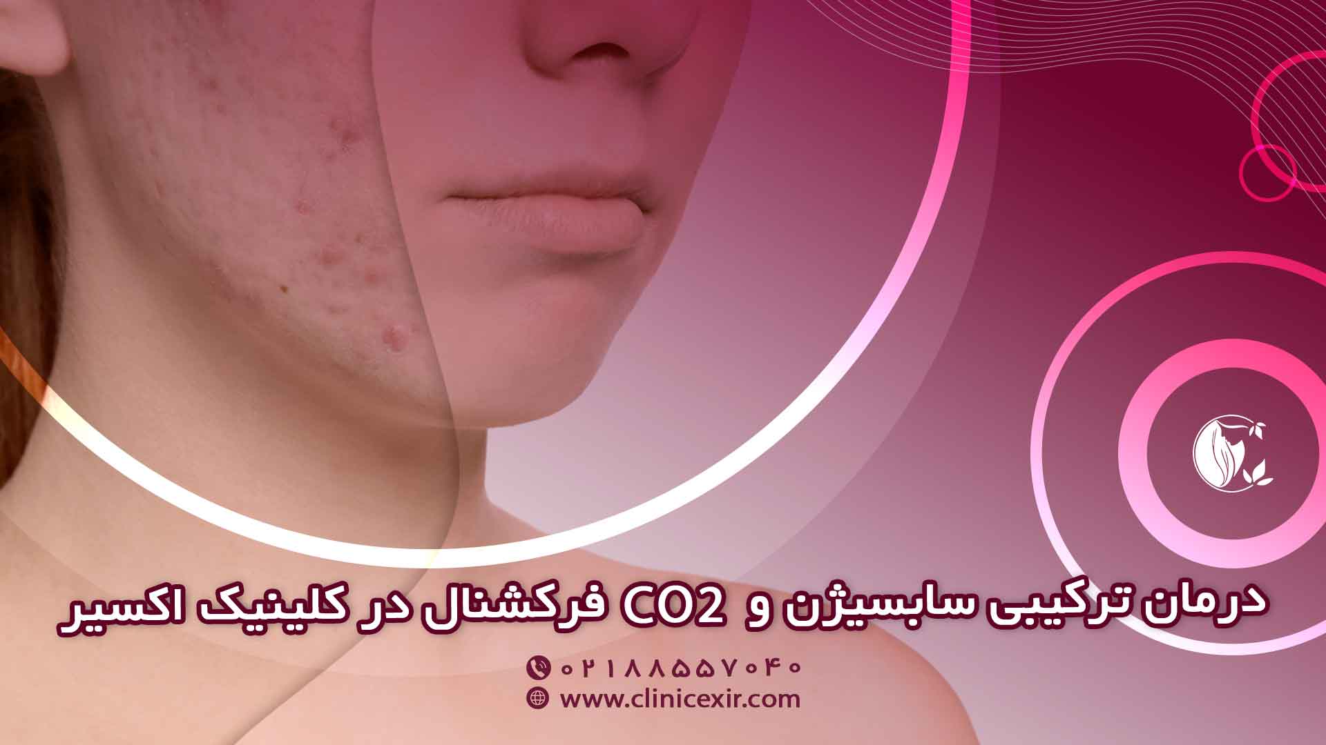 درمان ترکیبی سابسیژن و لیزر CO2 فرکشنال در کلینیک اکسیر