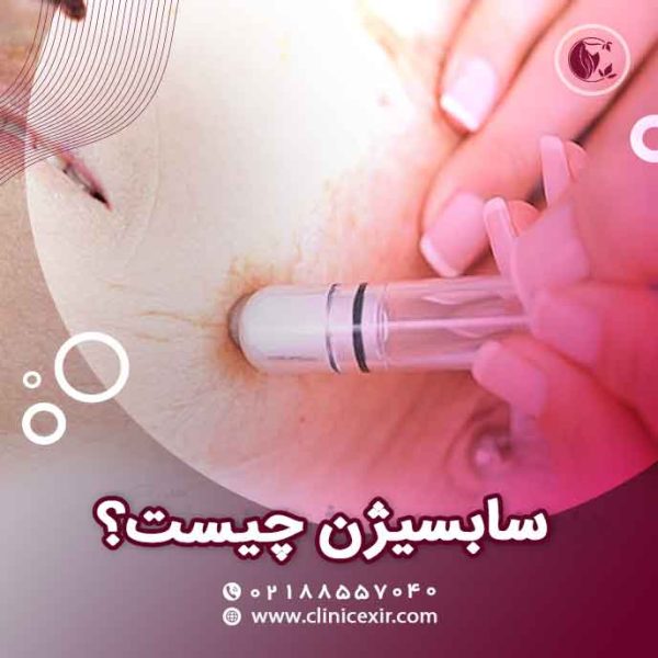 سابسیژن چیست