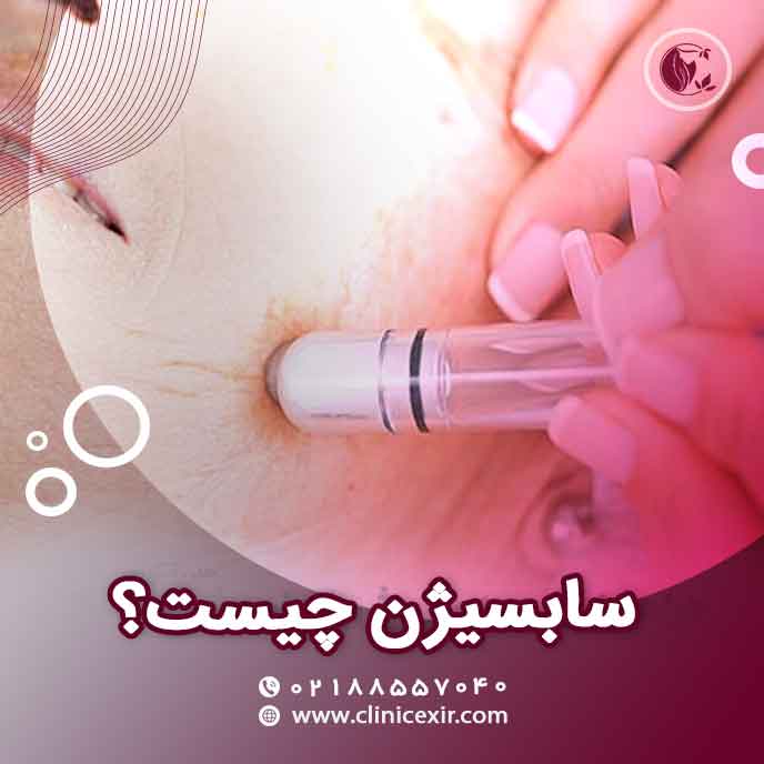 سابسیژن چیست