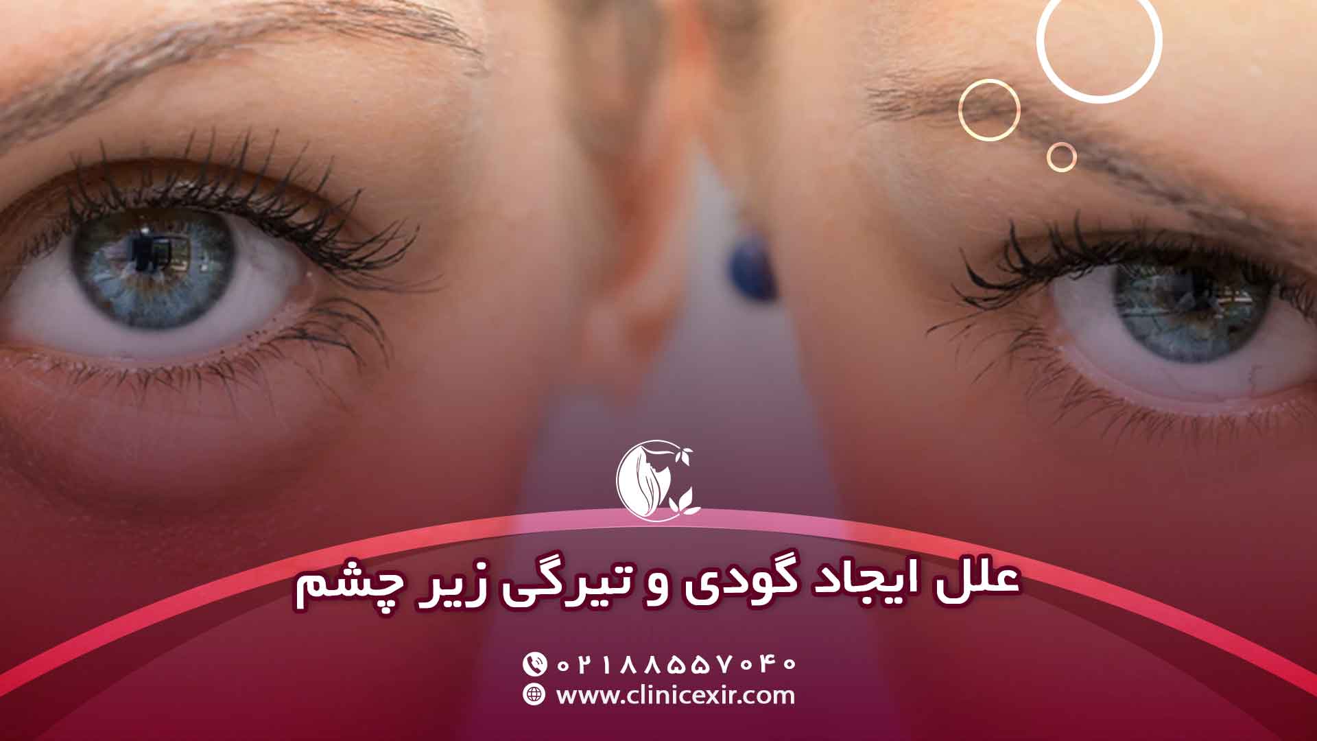 علل ایجاد گودی و تیرگی زیر چشم