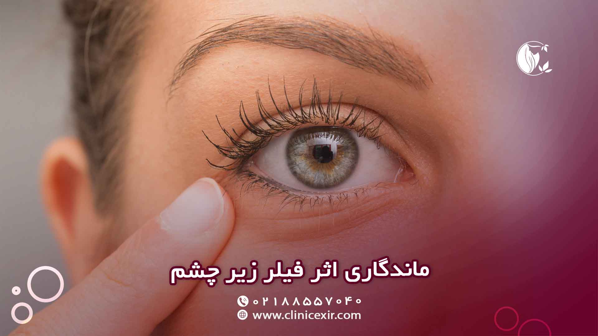 ماندگاری اثر فیلر زیر چشم