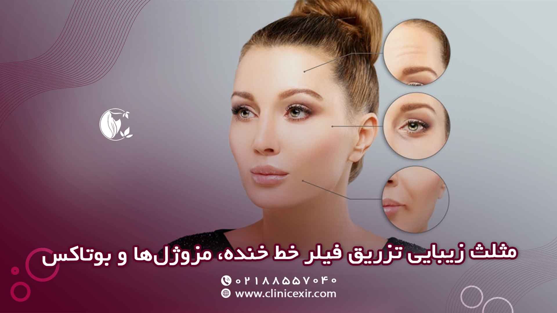 مثلث زیبایی با استفاده از تزریق ژل خط خنده، تزریق مزوژل‌ها و در نهایت بوتاکس