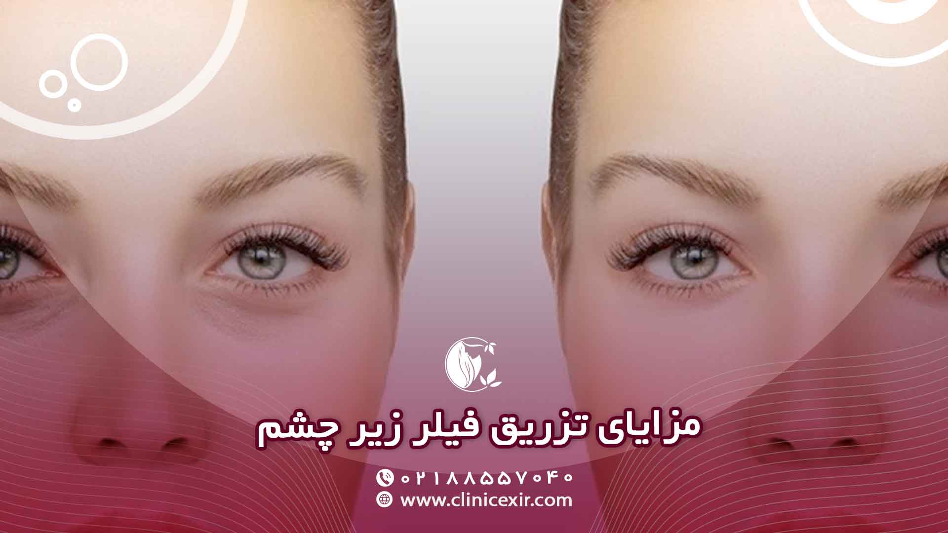 مزایای تزریق فیلر زیر چشم