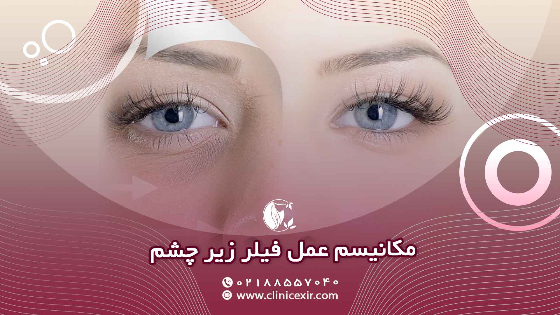 مکانیسم عمل فیلر زیر چشم