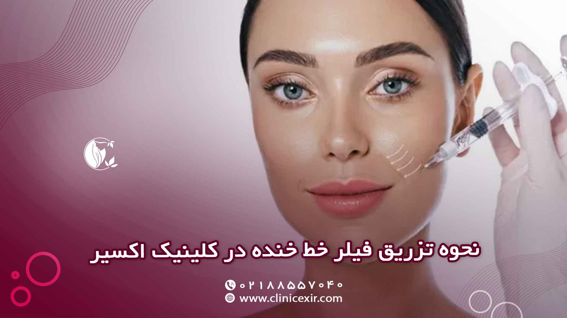 نحوه انجام تزریق ژل خط خنده در کلینیک اکسیر