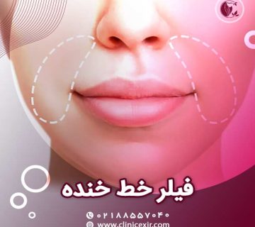 ژل خط خنده