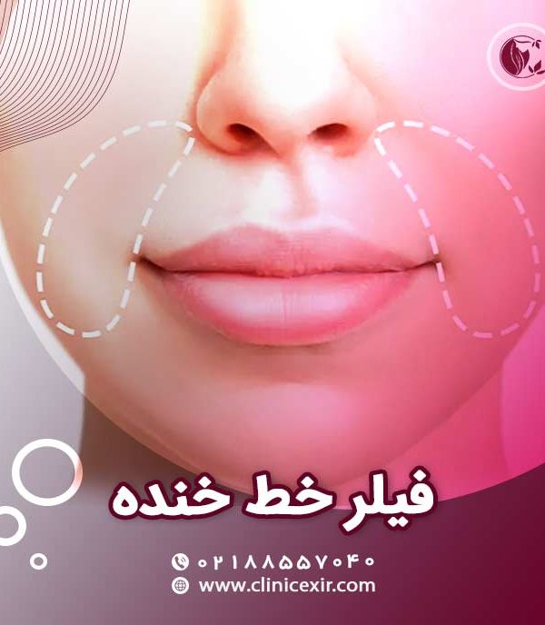 ژل خط خنده