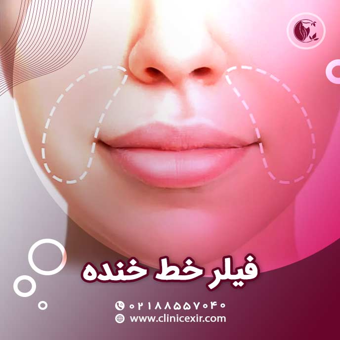 ژل خط خنده
