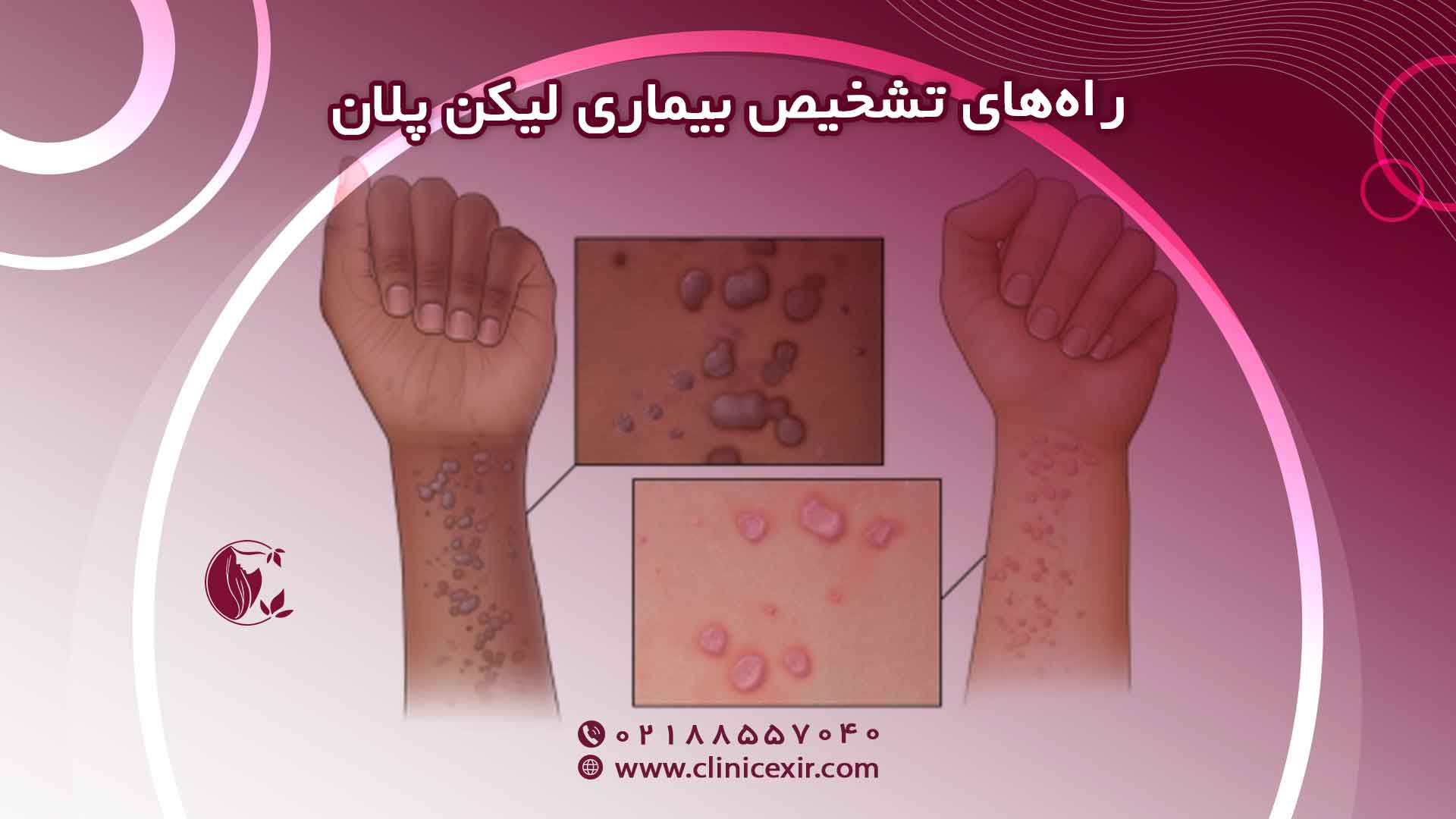 تشخیص لیکن پلان