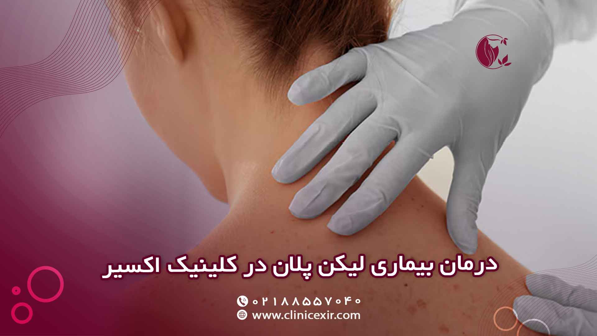 درمان بیماری لیکن پلان در کلینیک تخصصی و زیبایی اکسیر