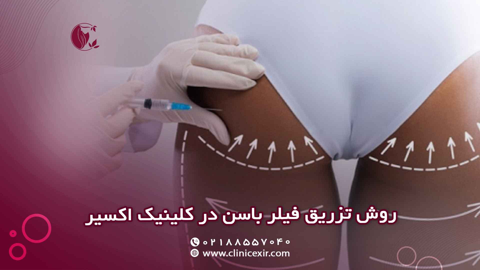 روش انجام تزریق ژل باسن در کلینیک اکسیر گام به گام