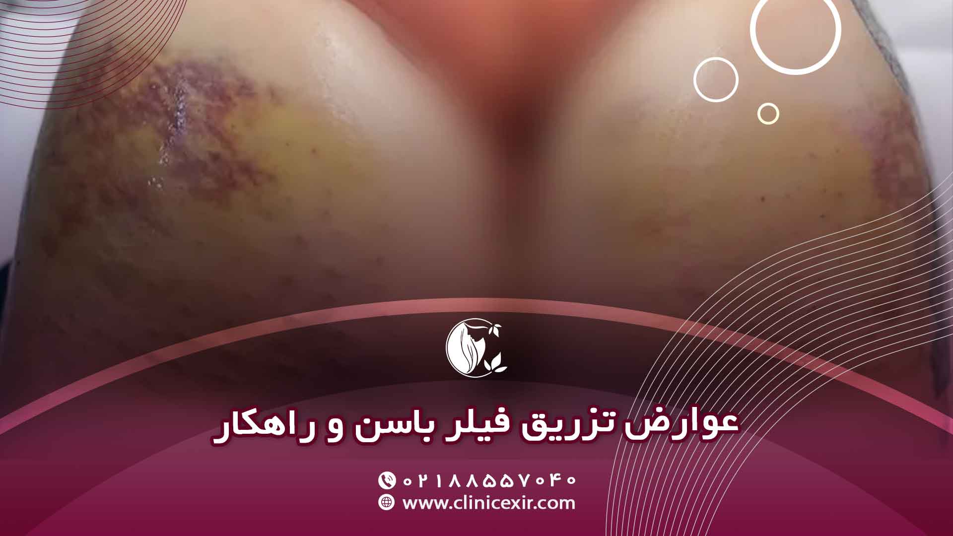 عوارض جانبی احتمالی تزریق ژل باسن و راهکارهای مدیریت