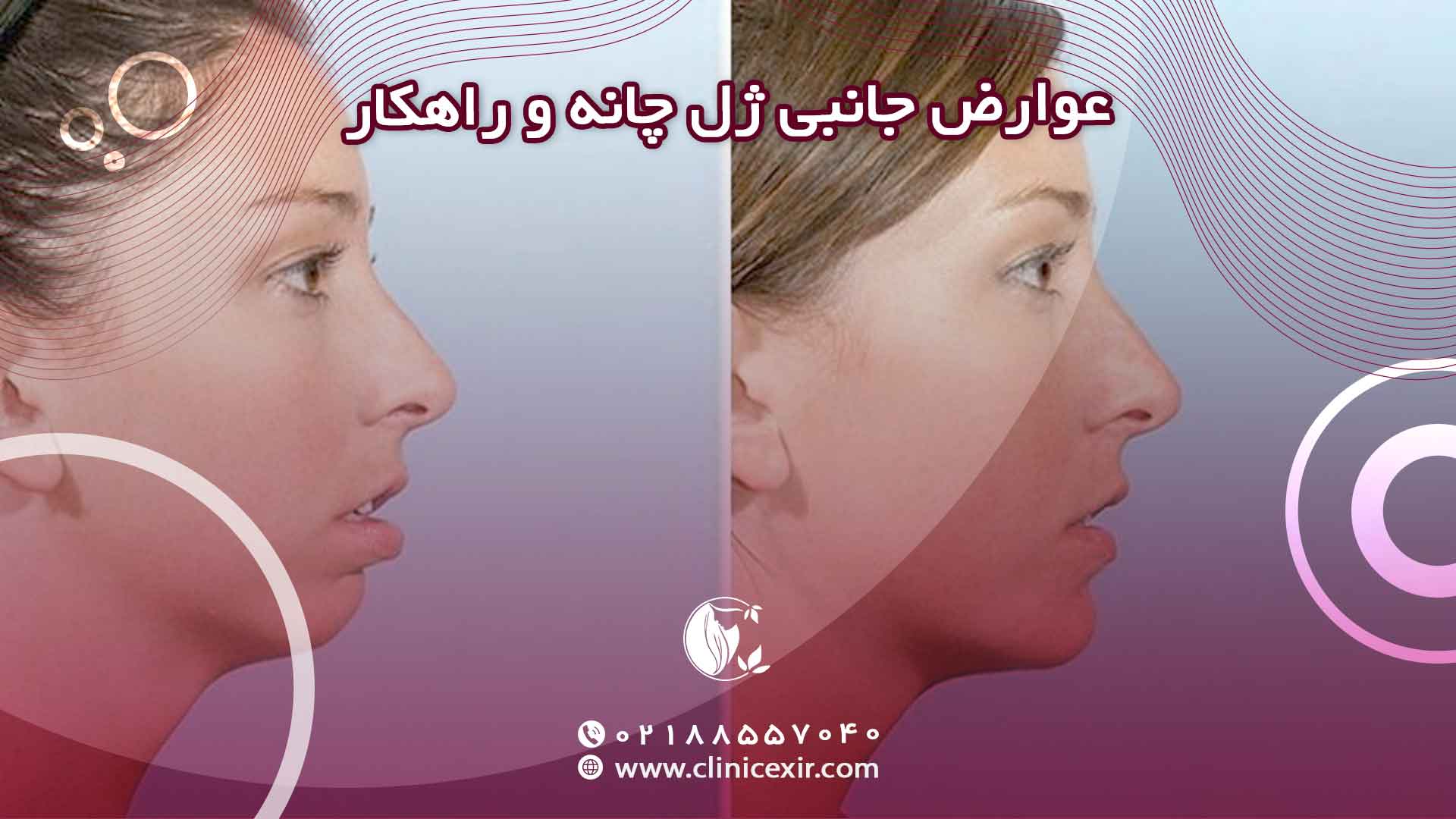 عوارض جانبی احتمالی ژل چانه و راهکارهای مدیریت