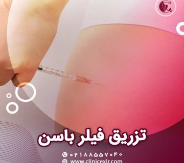 فیلر باسن