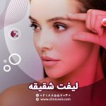 لیفت شقیقه