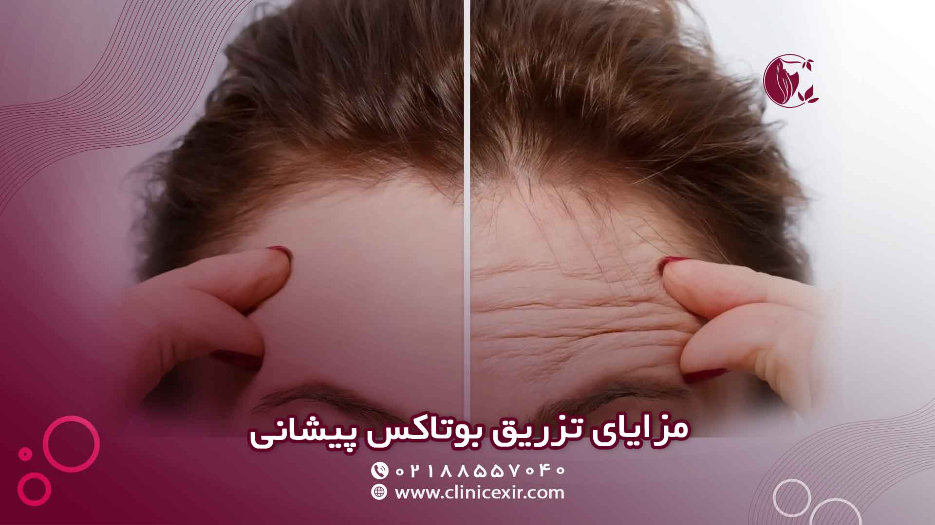 مزایای تزریق بوتاکس پیشانی