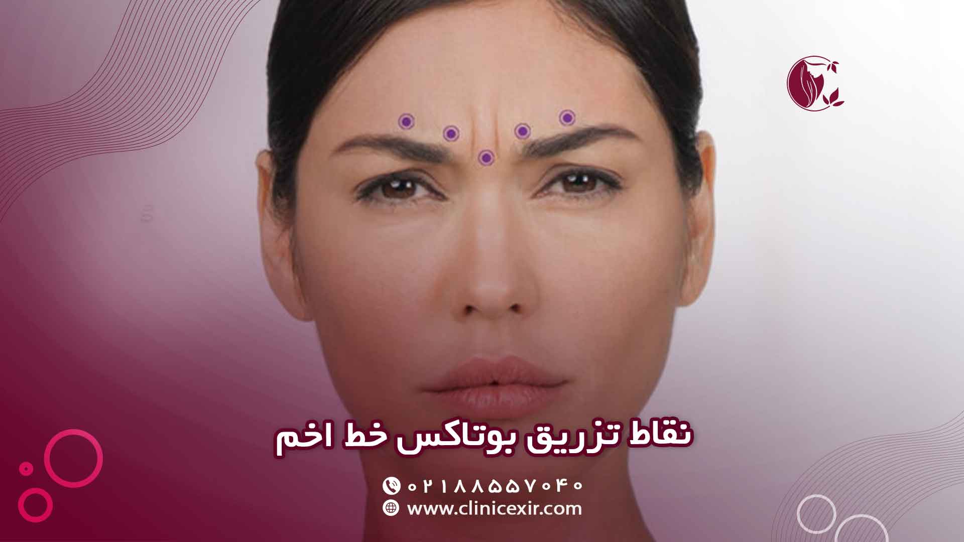 نقاط تزریق بوتاکس خط اخم شناخت عضلات هدف