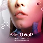 تزریق ژل چانه
