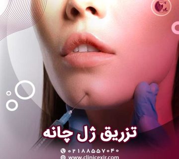 تزریق ژل چانه