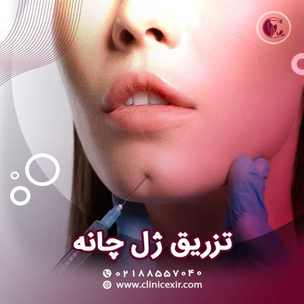 تزریق ژل چانه