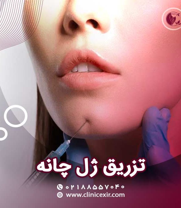 تزریق ژل چانه