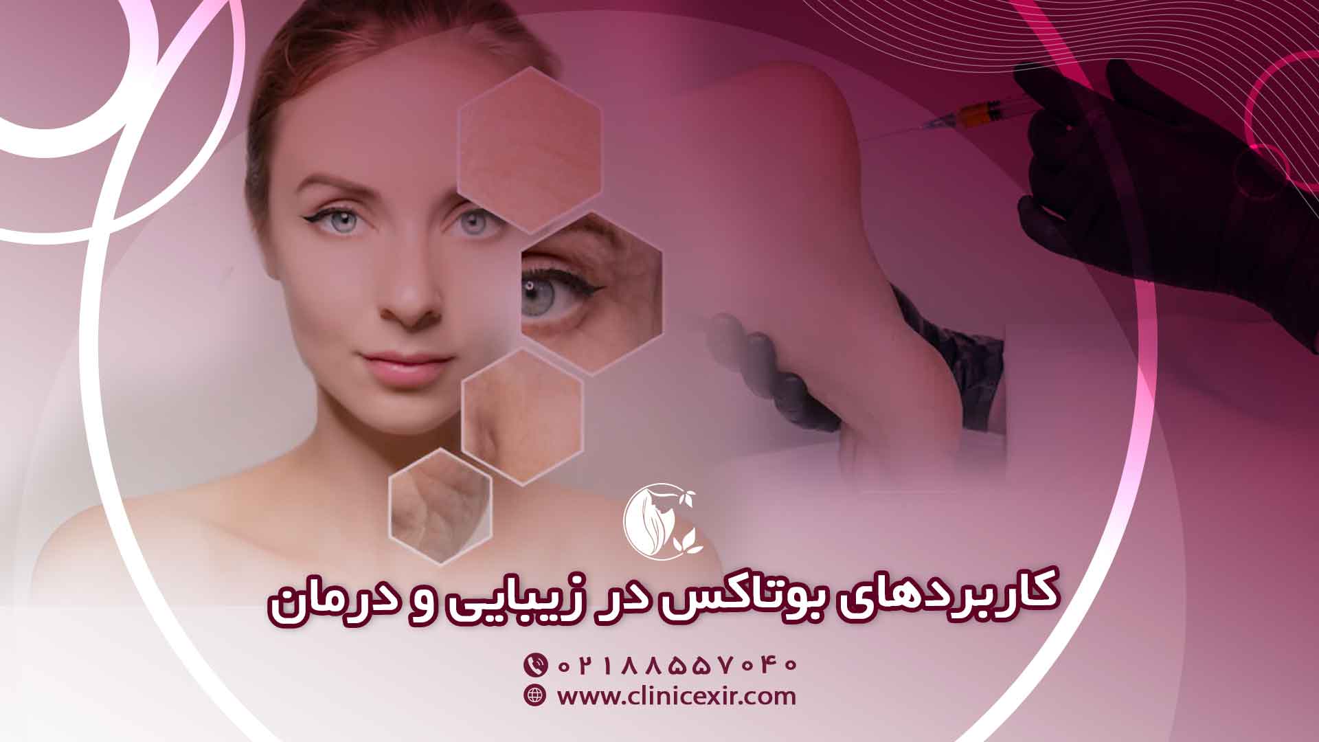 کاربردهای دیگر بوتاکس در زیبایی و درمان 