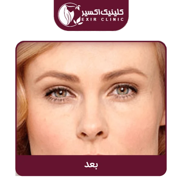 بعد بوتاکس