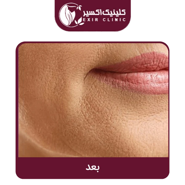 عکس بعد جوانسازی