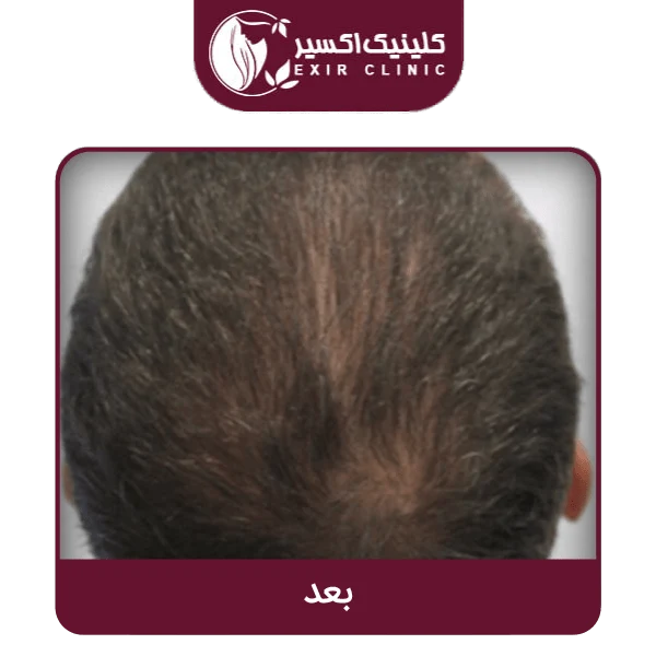 بعد مزوتراپی مو min