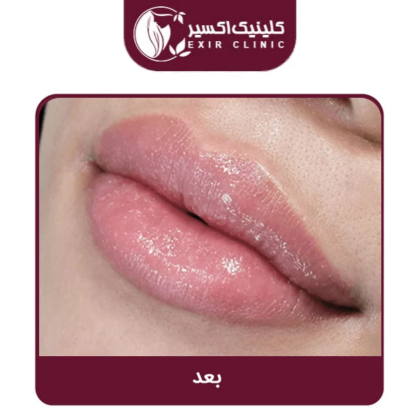 عکس بعد تزریق ژل