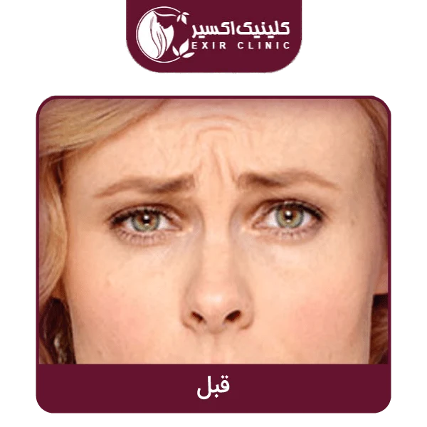 قبل بوتاکس