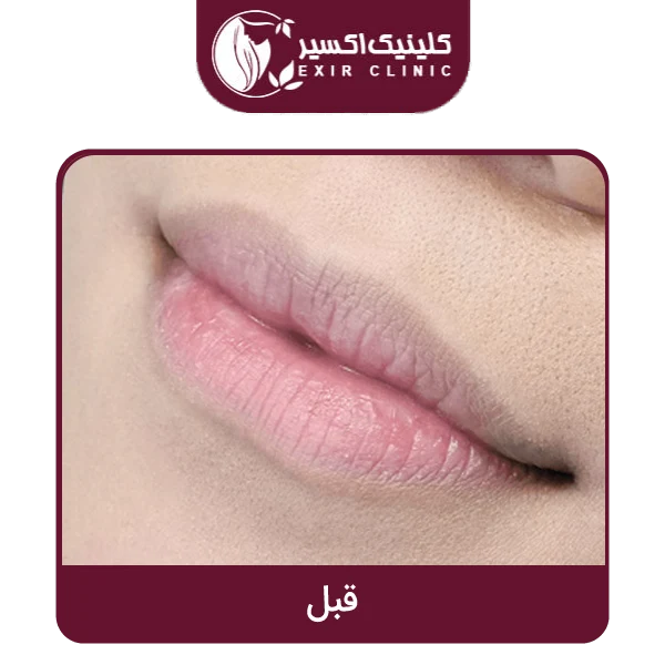عکس قبل تزریق ژل