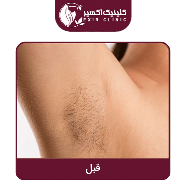 قبل از انجام لیزر زیر بغل