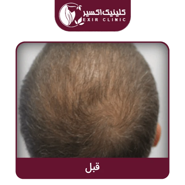 قبل مزوتراپی مو